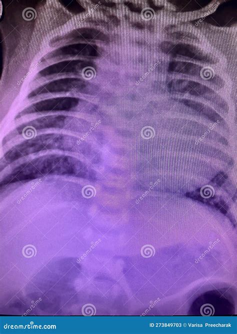 TOF x-ray stock image. Image of atrium, insufficiency - 273849703