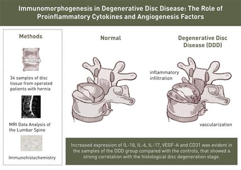 What Causes Degenerative Disc Disease In Young Adults at Timothy Mitchell blog