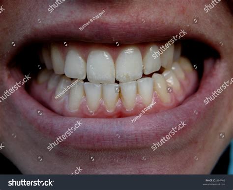 Daughter Grinds Teeth