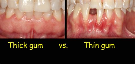 Unhealthy Gums And Mouth