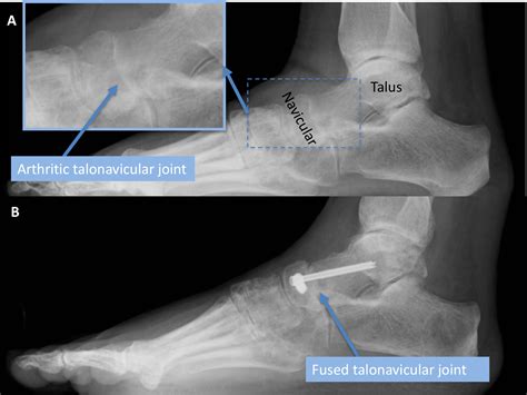 Talonavicular Arthitis | Arthritis Of The Talonavicular Joint