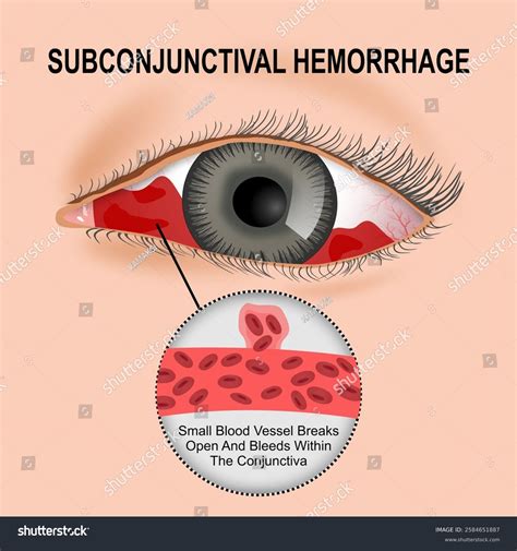 Subconjunctival Hemorrhage Diagram Subconjunctival Hemorrhage (broken