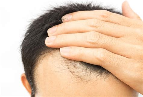 8 Natural Ways For Men To Regrow Hair Back From A Receding Hair Line
