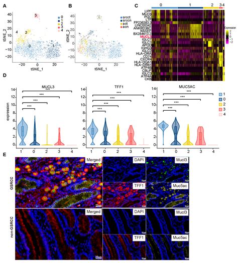 Single-Cell Transcriptomic Profiling Uncovers a Metastasis-Associated ...