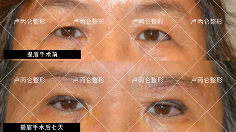 提眉手术的危害，提眉手术会留疤痕吗？（这些都是该了解的！）_腾讯新闻
