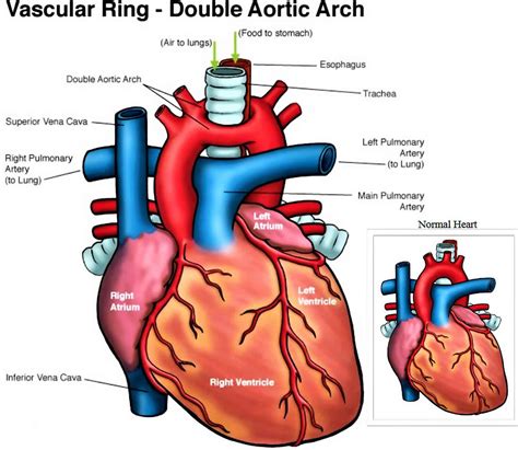 Double aortic arch causes, symptoms, diagnosis, treatment & prognosis