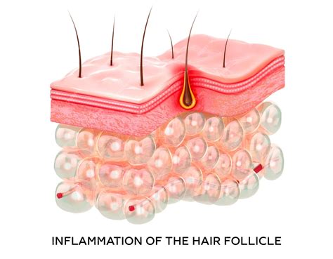 Premium Photo | Inflammation of the hair follicle 3d rendering realistic 3d illustration of skin ...