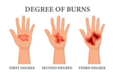 Burn stages. Burnt hands at various degrees. Skin burn symptoms ...