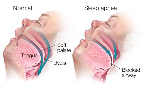 Sleep Apnea & Snoring Guards | Premier Dental Center - Ferndale, WA