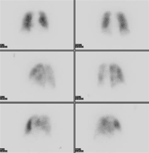 Lung Ventilation-Perfusion Scan
