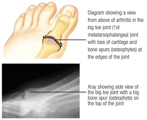 Minimally Invasive Cheilectomy Surgery | David Redfern Orthopaedic Surgeon