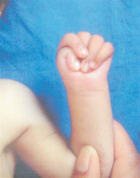 Freeman Sheldon Syndrome