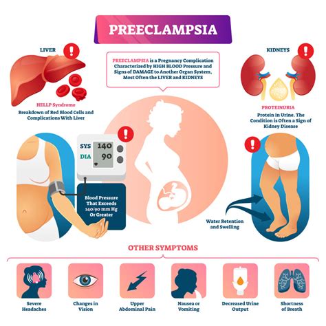 Preeclampsia Edema