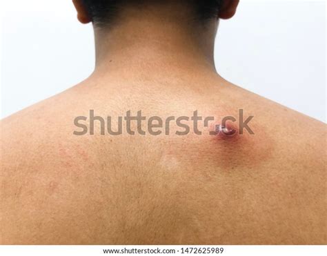 Image result for Giant Abscess Exploding On Back