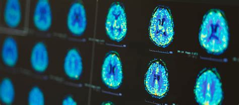 How to Manage Aggressive Behavior in Dementia Patients – HelpDementia.com
