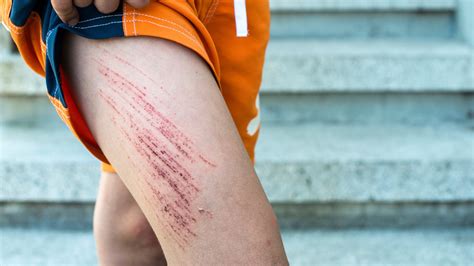 #1 Expert Labosport Skin Injury Test Service | Labosport