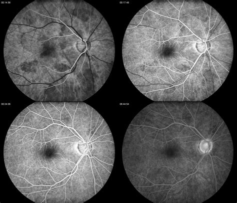 Phases Of Fluorescein Angiography