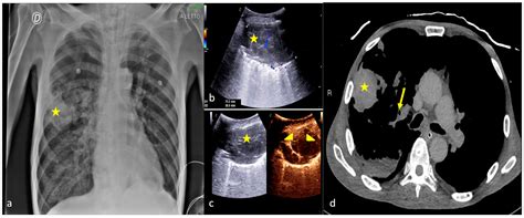Point-of-Care Lung Ultrasound in the Intensive Care Unit—The Dark Side ...