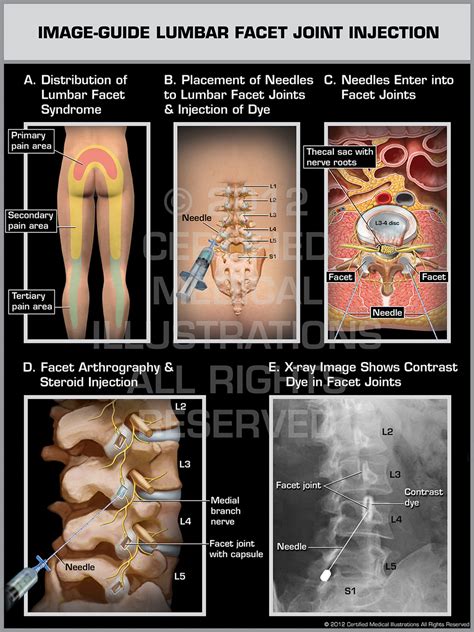 Image-Guide Lumbar Facet Joint Injection Male