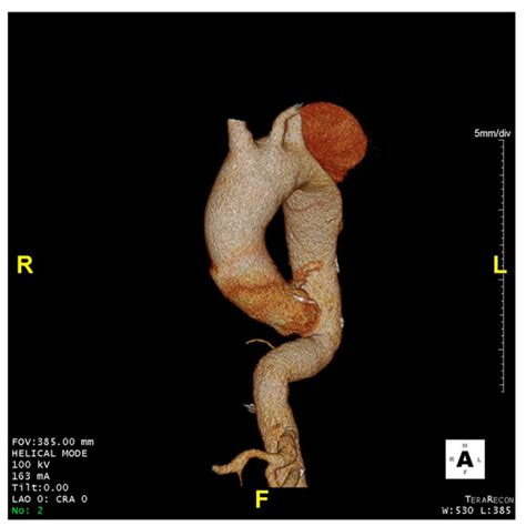 Alternative Approach for Cerebral Protection during Complex Aortic Arch ...