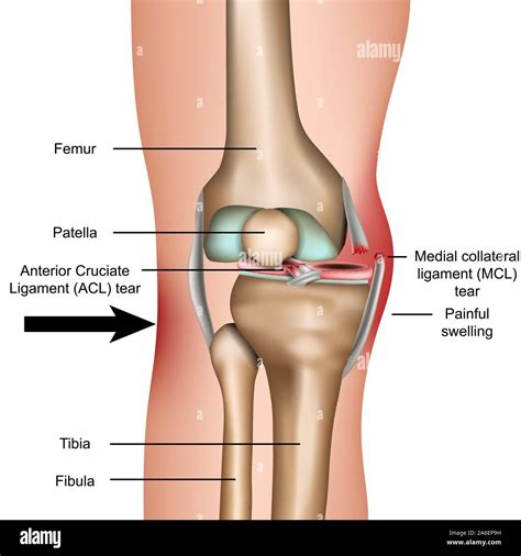 Medial collateral ligament hi-res stock photography and images - Alamy