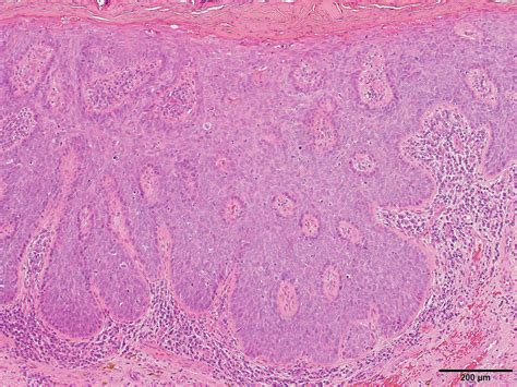 Erythroplasia Of Queyrat