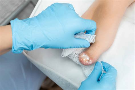 Blister Prevention Methods: Best Blister Care and Treatment