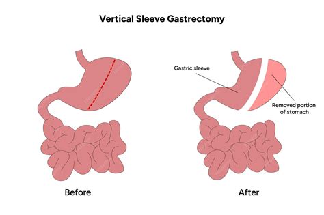 Premium Vector | Vertical Sleeve Gastrectomy Gastric