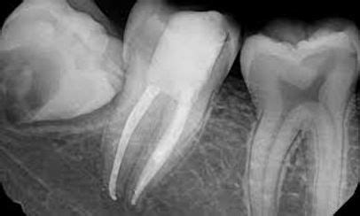 Root Canal Treatment | Dental Arch Gurgaon