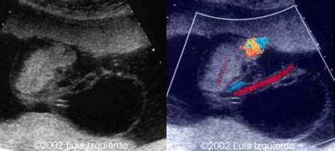 Bildergebnis für umbilical cord abnormalities ultrasound