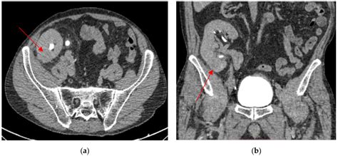 Urothelial Carcinoma Arising on a Functional Kidney Graft