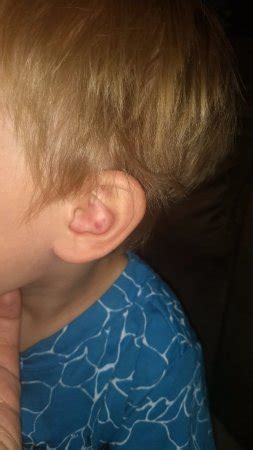Dr bhb bruising on toddler ear, pic | BabyCenter