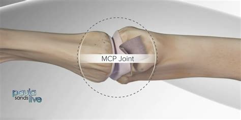 Suffering from ‘skier’s thumb’? How to repair ulnar collateral ligament ...