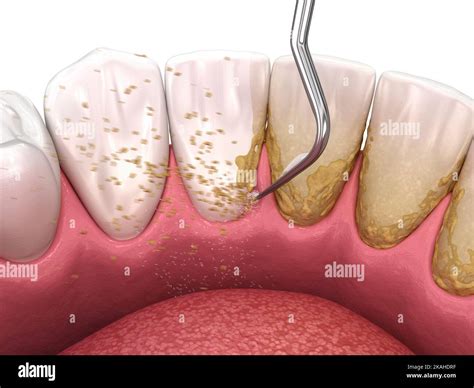 Oral hygiene: Scaling and root planing (conventional periodontal therapy). Medically accurate 3D ...