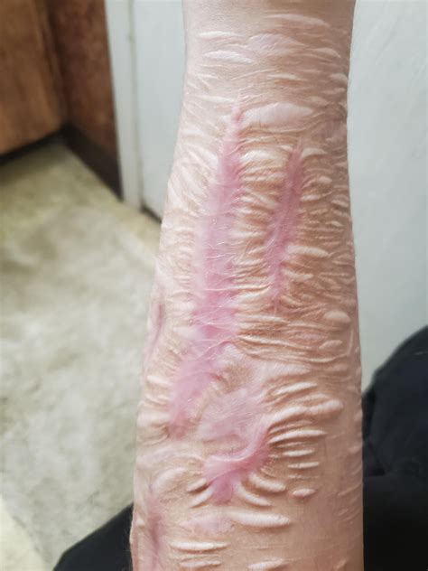 Tattoos Vs Scar Revision Surgery? : r/SelfHarmScars