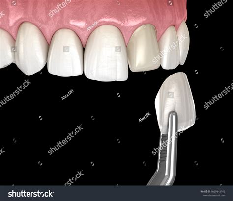 Veneer Teeth Process Video at Zoe Szabados blog