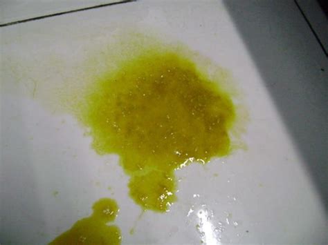 肠炎大便图片结肠炎大便不成形2022已更新今日图集