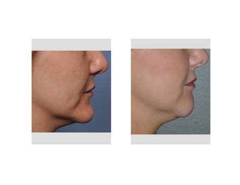 Case Study: Horizontal Chin Reduction in a Female - Explore Plastic Surgery