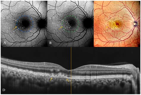 Blue Light and Green Light Fundus Autofluorescence, Complementary to Optical Coherence ...