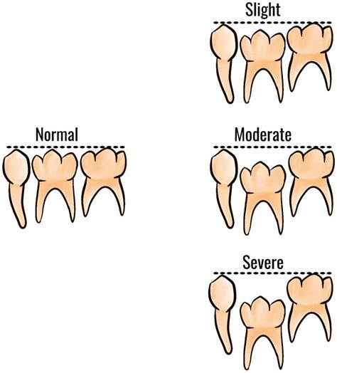 Therapeutic Strategies of Primary Molar Infraocclusion: A Systematic Review