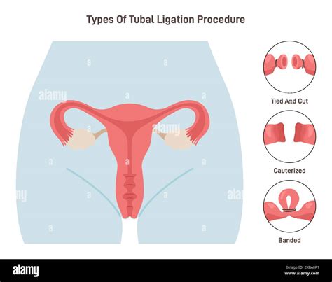 Types Of Tubal Ligation 60+ Tubal Ligation Stock Photos, Pictures