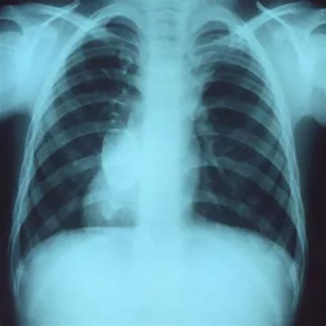 Atelectasis in Obese Patients Undergoing Bariatric Surgery