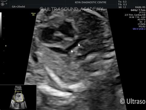 TAPVC SUPRACARDIAC TYPE – Case By Dr. Nitin Jadhav