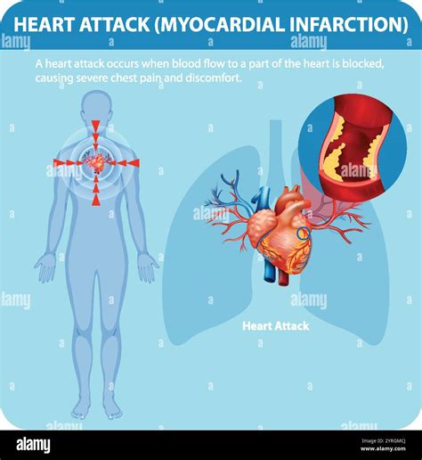 Illustration of heart attack causes and symptoms Stock Vector Image & Art - Alamy