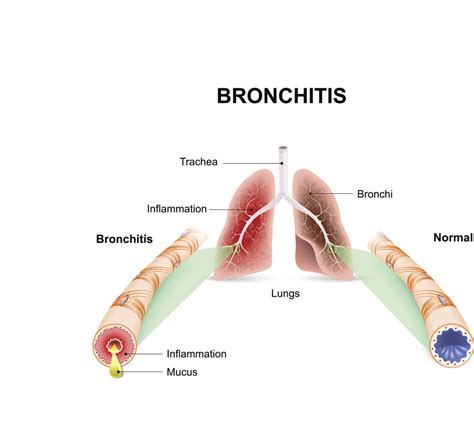 Chest X Ray Bronchitis Vs Pneumonia