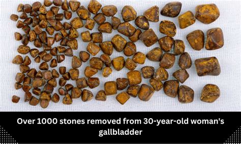 Over 1000 stones removed from 30-year-old woman's gallbladder