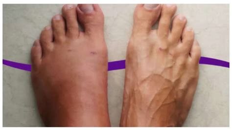 7 signs of early kidney disease seen in legs and hands