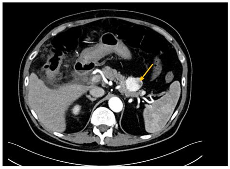 Safety and Efficacy of Surgery for Metastatic Tumor to the Pancreas: A Single-Center Experience