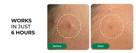 Shop Self Dissolving Microneedle Acne Patches | 8 Patches for Healthy ...