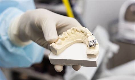 Tooth Crown Cement 的图像结果